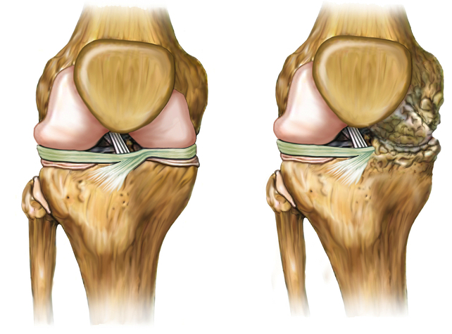 Corticoides intraarticulares: pérdida de cartílago y dolor de rodilla en artrosis